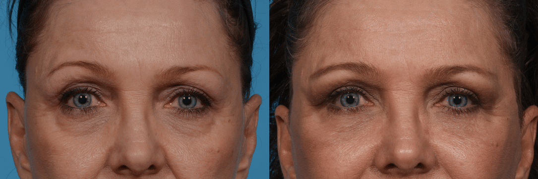 Before and After Image: Eyelid Surgery - front