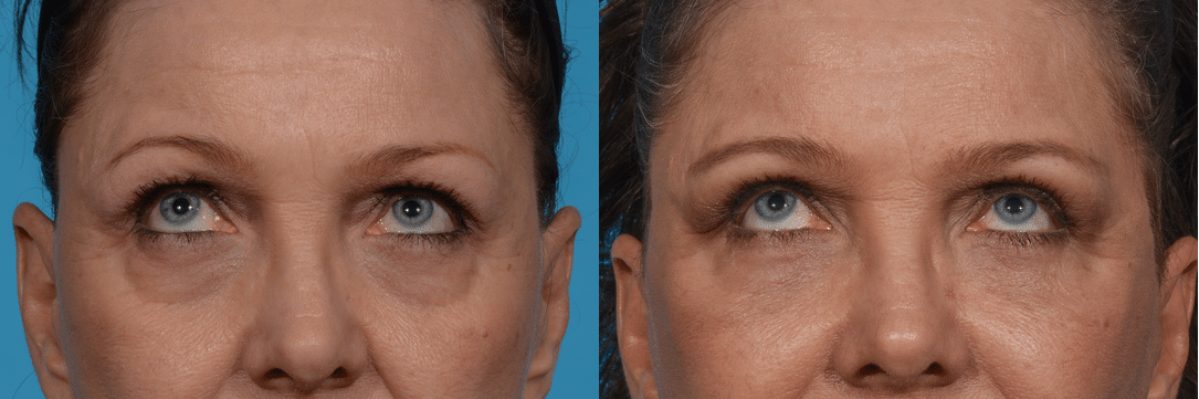 Before and After Image: Eyelid Surgery - front