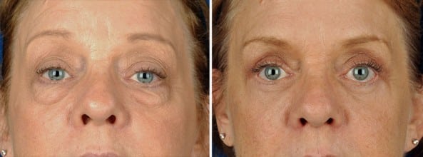 Before and After Image: Eyelid Surgery - front