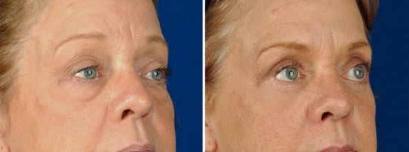 Before and After Image: Eyelid Surgery - right-front-oblique