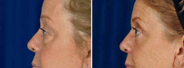 Before and After Image: Eyelid Surgery - left-side