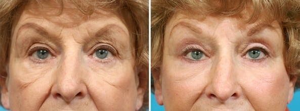 Before and After Image: Eyelid Surgery - front