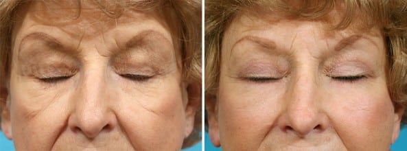 Before and After Image: Eyelid Surgery - front