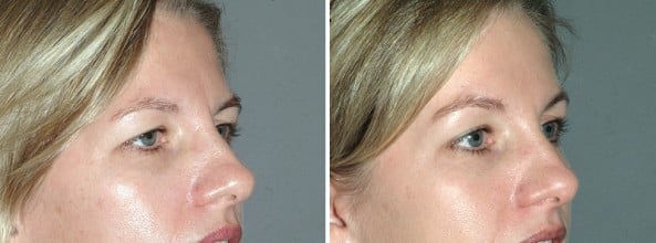 Before and After Image: Eyelid Surgery - right-front-oblique