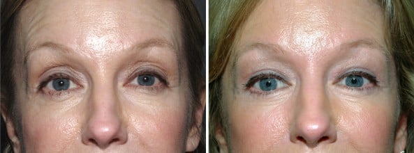 Before and After Image: Eyelid Surgery - front