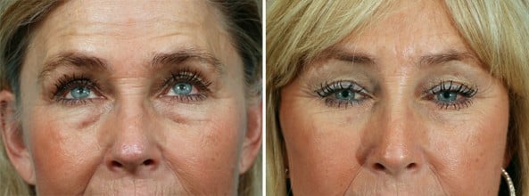 Before and After Image: Eyelid Surgery - front