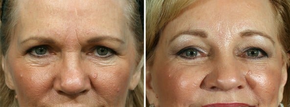 Before and After Image: Eyelid Surgery - front
