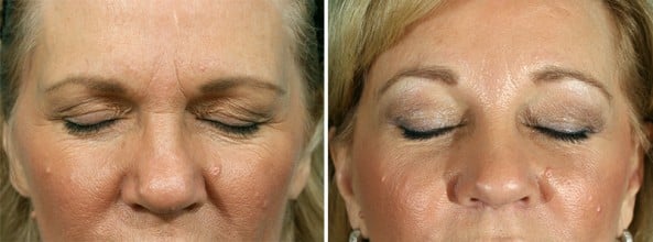 Before and After Image: Eyelid Surgery - front