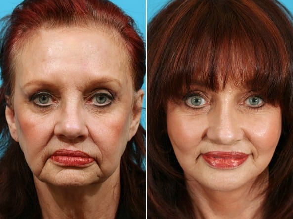 Before and After Image: Eyelid Surgery - front