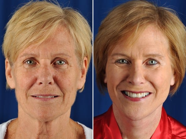 Before and After Image: Facelift - front