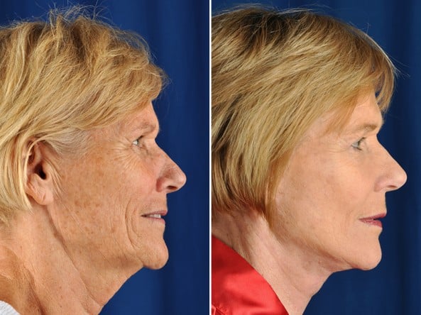 Before and After Image: Facelift - right-side
