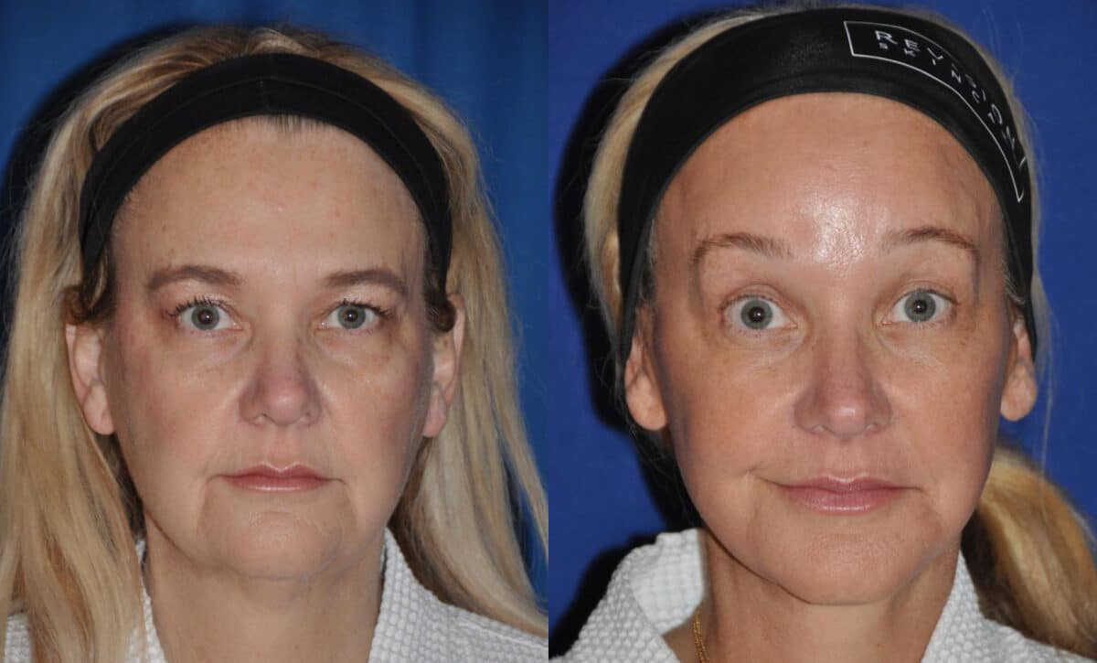 Before and After Image: Facelift - front