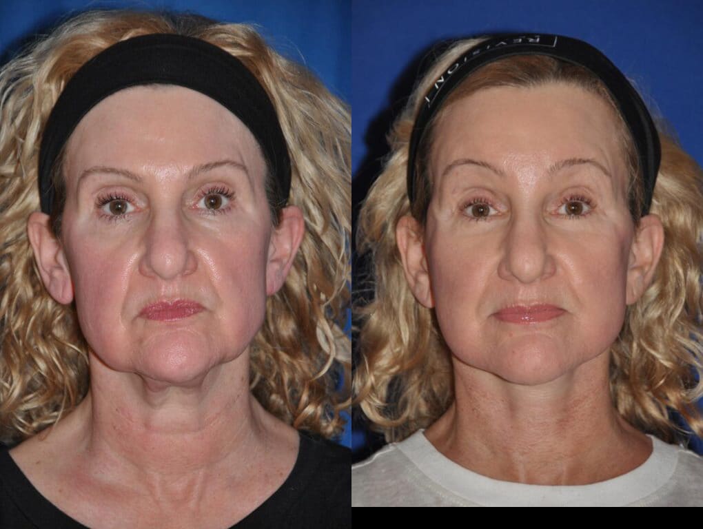 Before and After Image: Facelift - front
