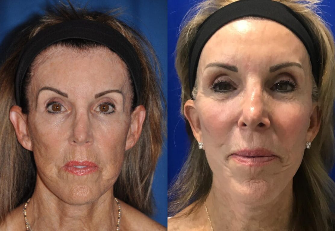 Before and After Image: Facelift and Fat Transfer - front
