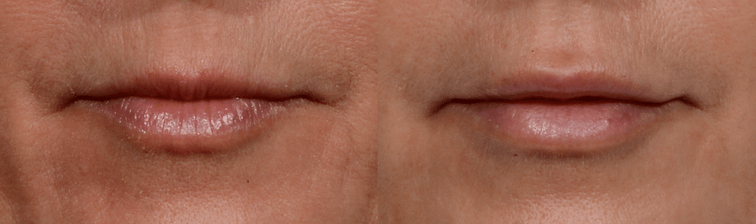 Before and After Image: Fat Grafting - front