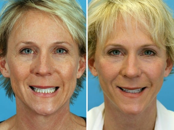 Before and After Image: Facelift - front