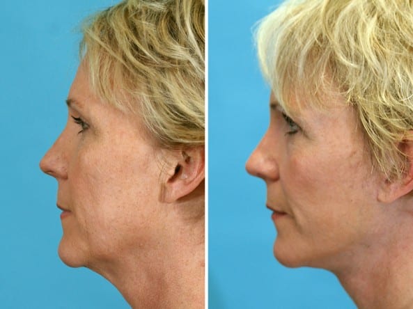 Before and After Image: Facelift - left-side