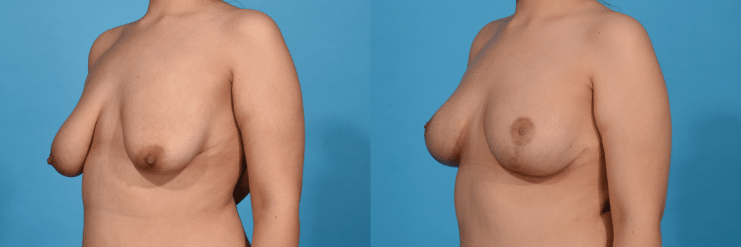 Before and After Image: Fat Grafting - left-front-oblique