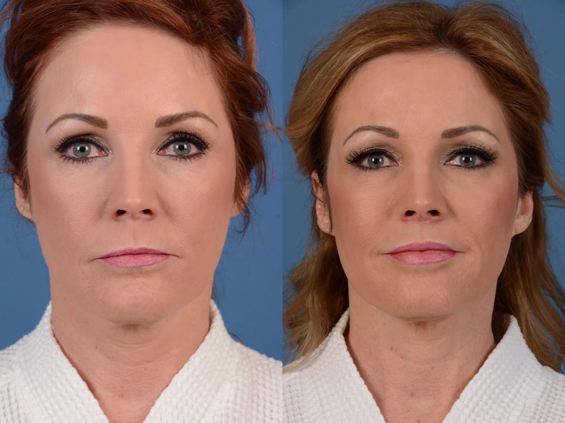 Before and After Image: Lip Lift - front