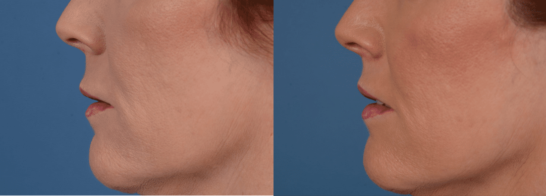Before and After Image: Lip Lift - left-side