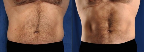 Before and After Image: Liposuction - front