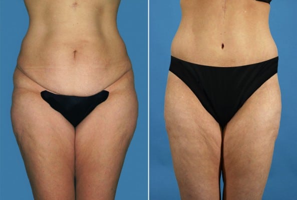 Before and After Image: Liposuction - front