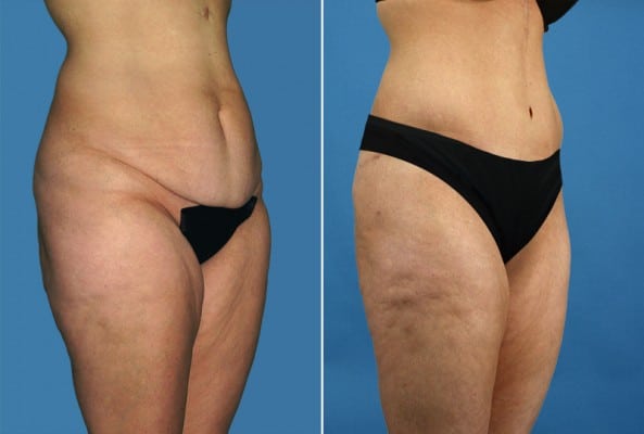 Before and After Image: Liposuction - right-front-oblique