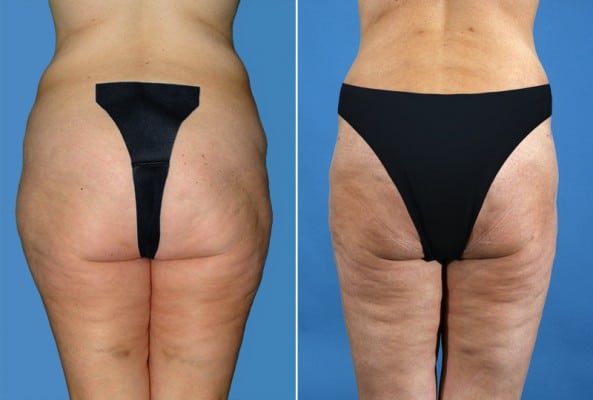 Before and After Image: Liposuction - back