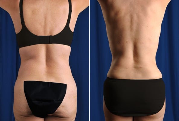 Before and After Image: Liposuction - back