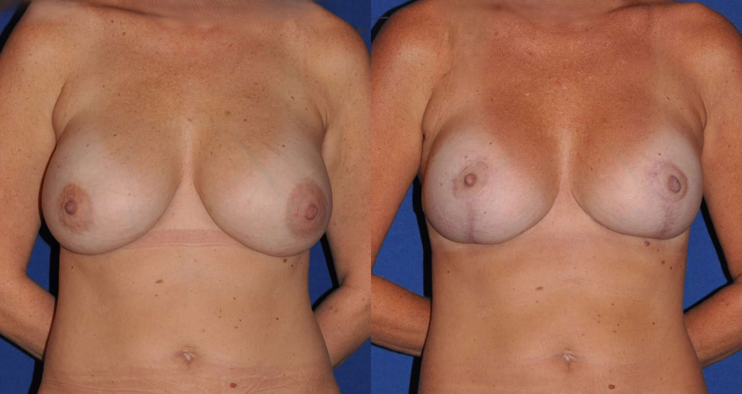 Before and After Image: Breast Implant Exchange - front