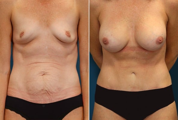 Before and After Image: Mommy Makeover - front