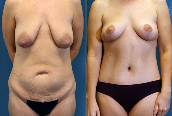 Before and After Image: Mommy Makeover - front