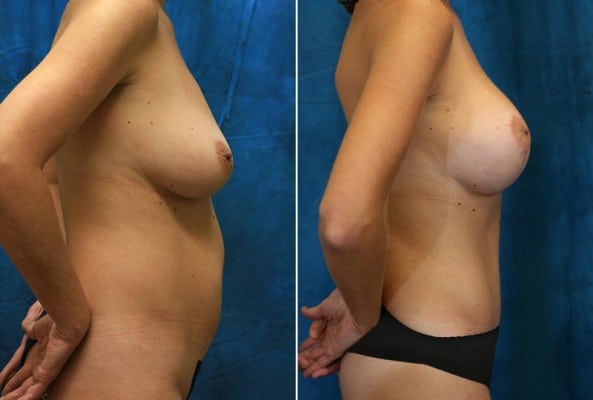 Before and After Image: Mommy Makeover - right-side