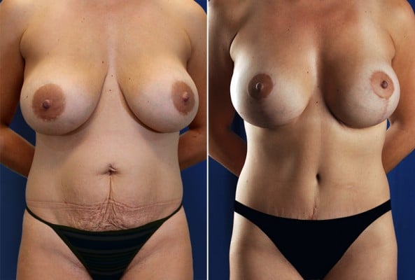 Before and After Image: Mommy Makeover - front