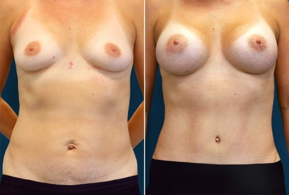 Before and After Image: Mommy Makeover - front