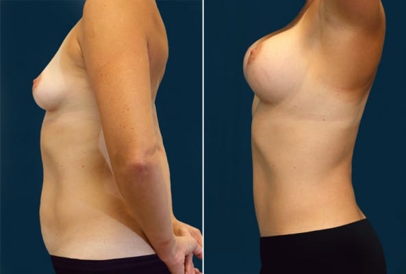 Before and After Image: Mommy Makeover - left-side