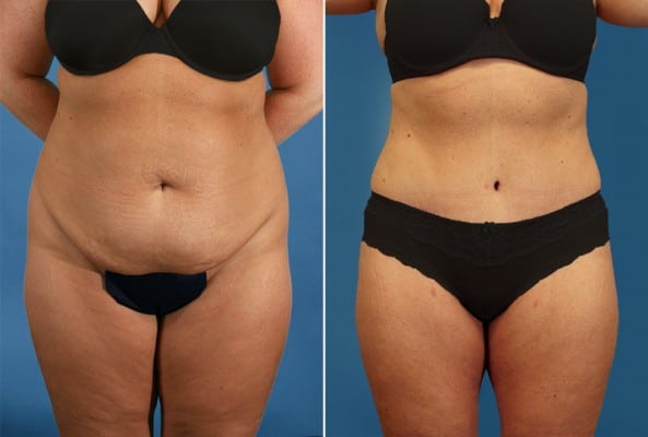 Before and After Image: Mommy Makeover - front