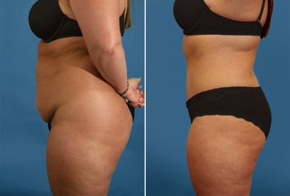 Before and After Image: Mommy Makeover - left-side