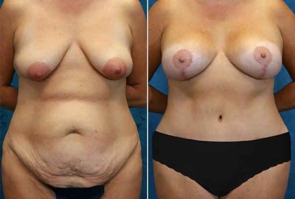 Before and After Image: Mommy Makeover - front