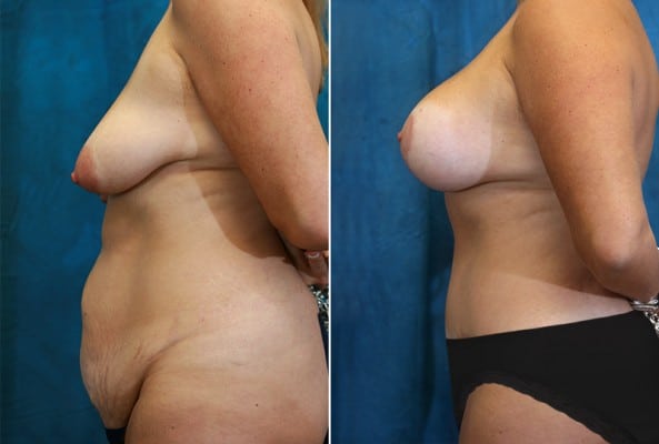 Before and After Image: Mommy Makeover - left-side