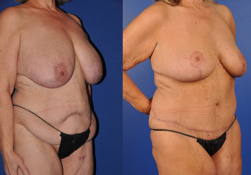 Before and After Image: Mommy Makeover - right-front-oblique