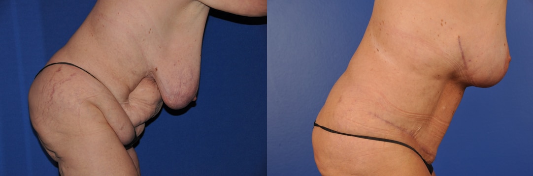 Before and After Image: Mommy Makeover - other