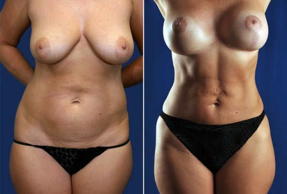 Before and After Image: Mommy Makeover - front