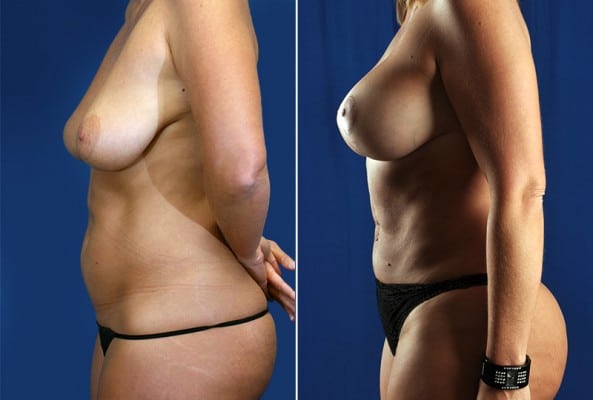 Before and After Image: Mommy Makeover - left-side