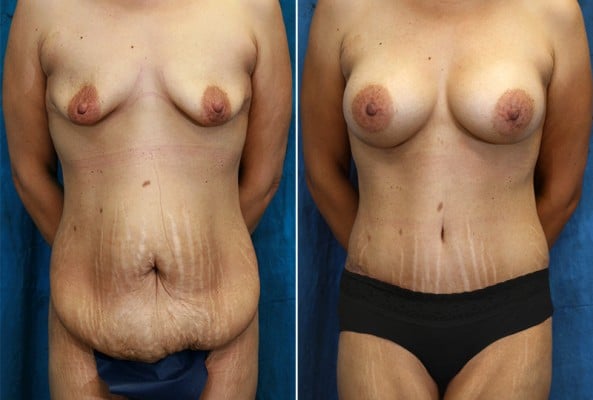 Before and After Image: Mommy Makeover - front