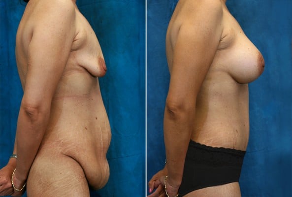 Before and After Image: Mommy Makeover - right-side