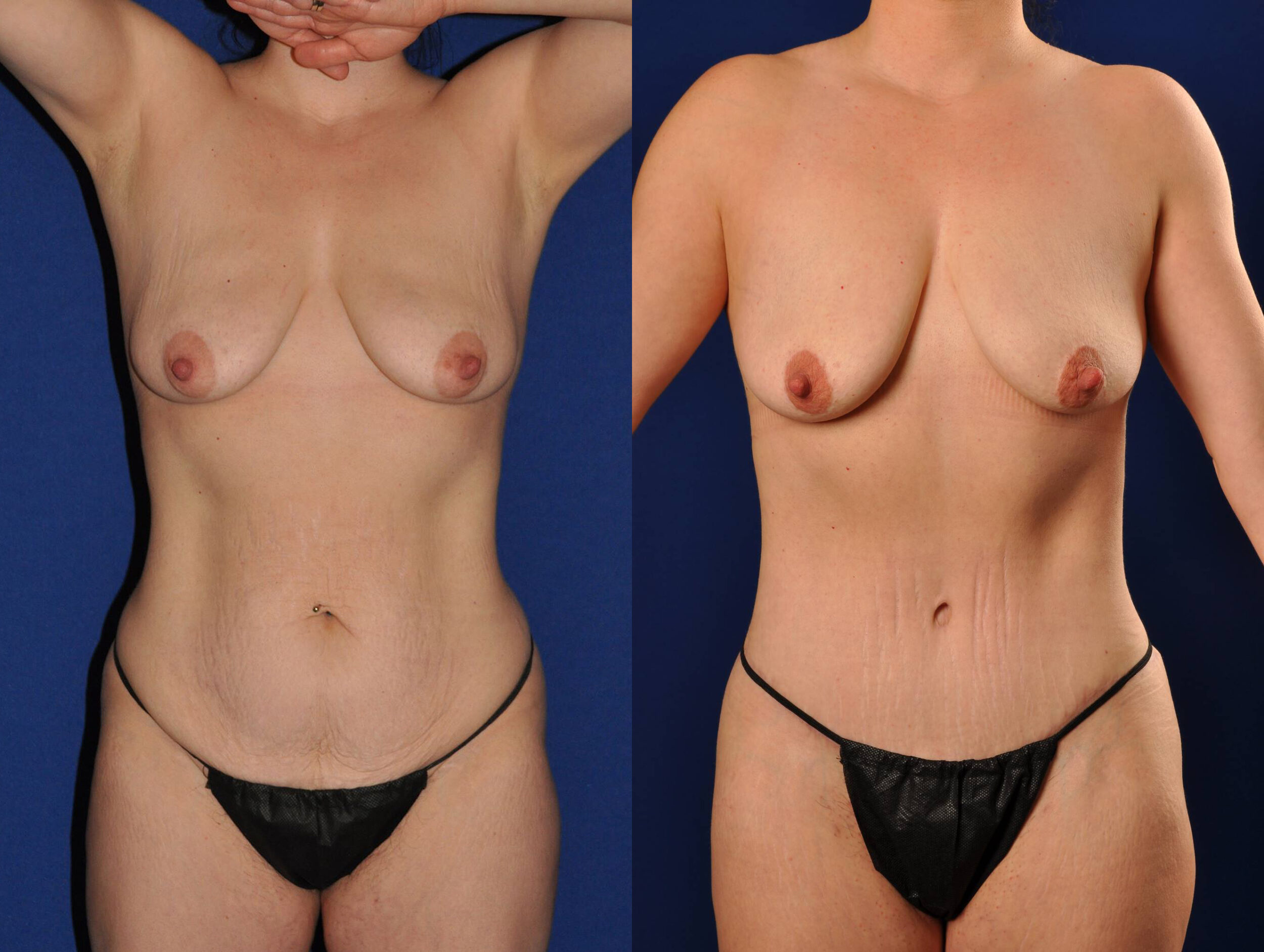 Before and After Image: Mommy Makeover - front