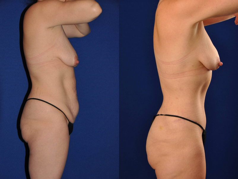 Before and After Image: Mommy Makeover - right-side