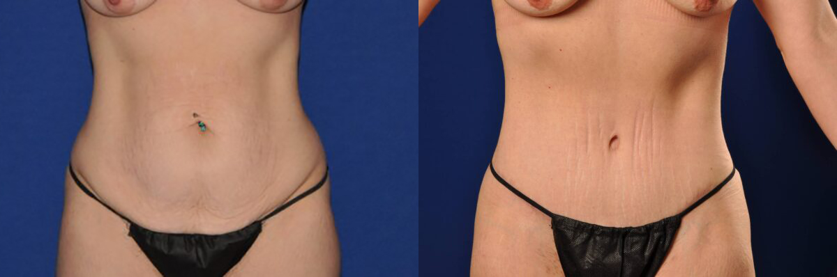 Before and After Image: Mommy Makeover - front