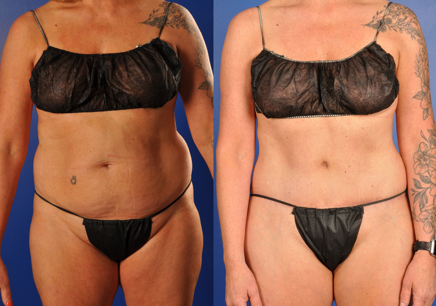 Before and After Image: Mommy Makeover - front